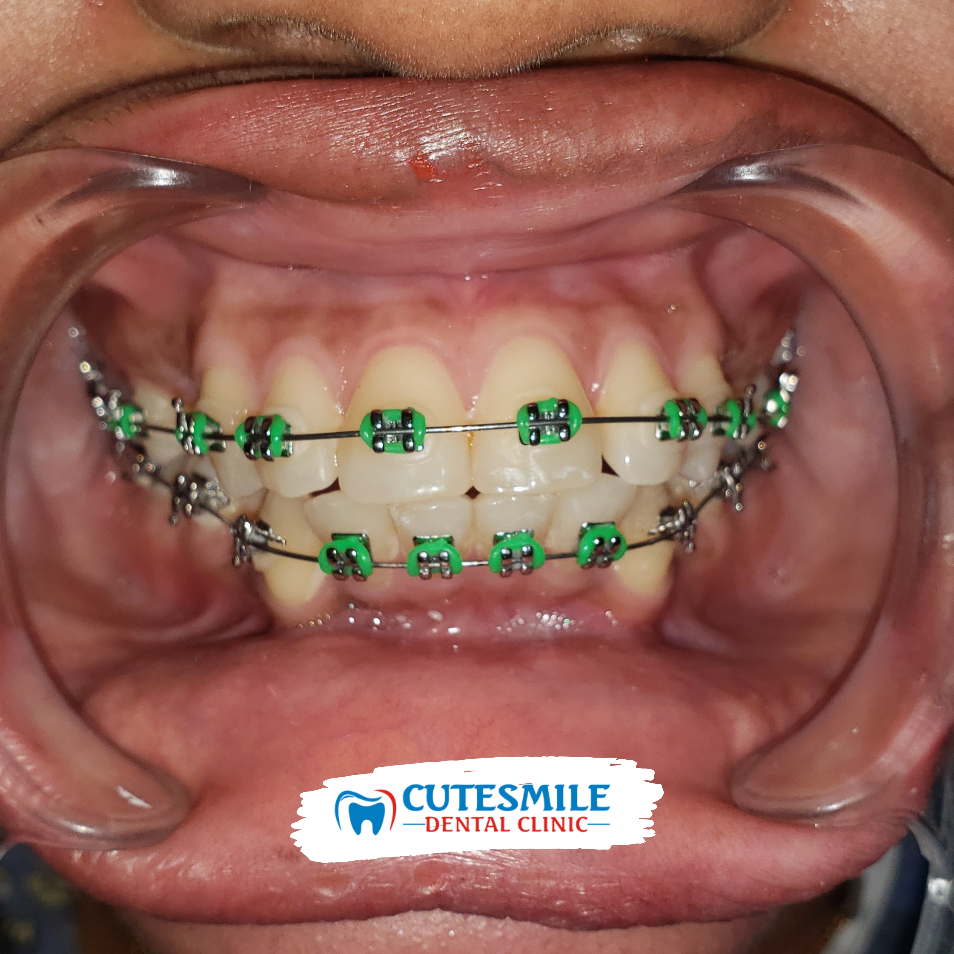 Benefits of Braces Braces In Port Harcourt