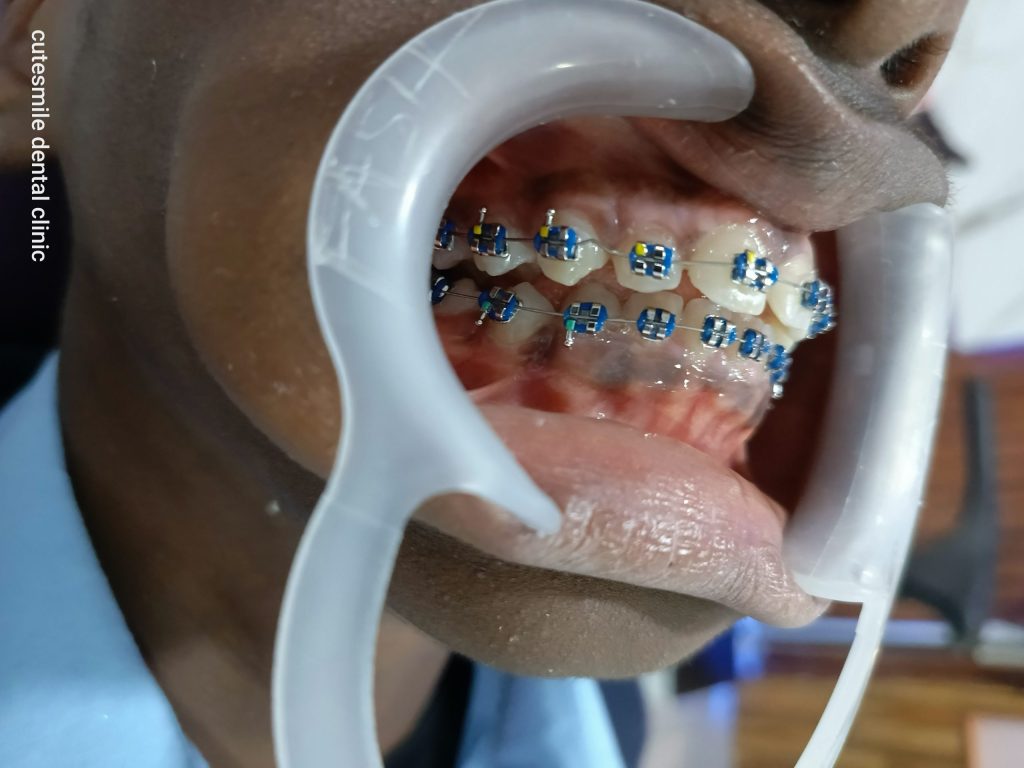 braces